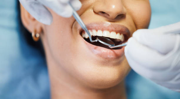 Best Knocked-Out Tooth (Avulsed Tooth) Treatment in Freeport, FL